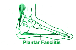 Plantar fasciitis